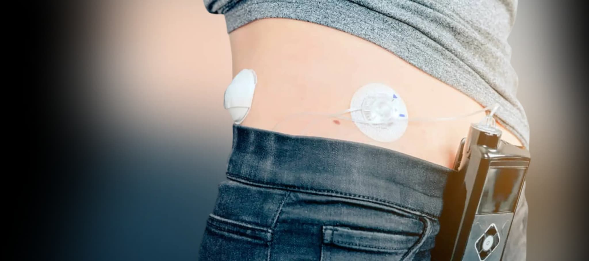 Artificial Pancreas