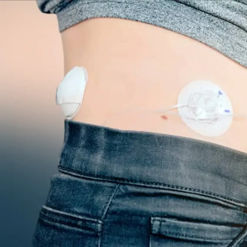 Artificial Pancreas